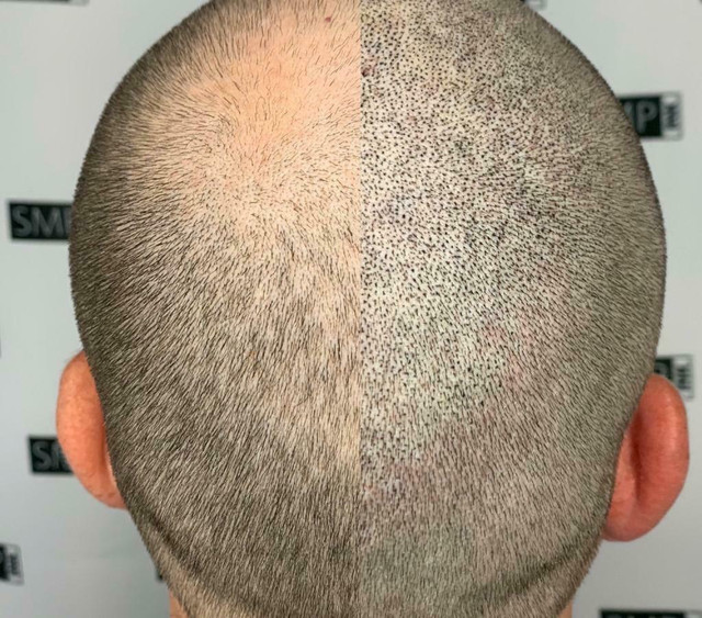 SMP , Scalp Pigmentation , Scalp MicroPigmentation, Barber, Hair Implants, Hair tattoo, Bald spot, Male Baldness Pattern in Health & Special Needs in Toronto (GTA) - Image 2