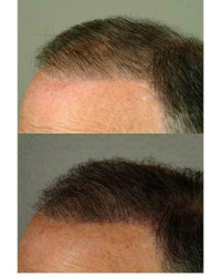 SMP, Scalp Pigmentation, Hair Follicles, Hair Transplant, baldness pattern, male baldness pattern,