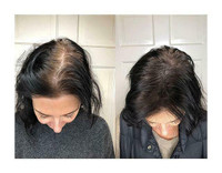 Scalp Pigmentation (SMP),  Hair Tattoo, Phi-Scalp, hair transplant, hair style, SMP, Scalp MicroPigmentation, beauty,