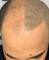 SMP , Scalp Pigmentation , Scalp MicroPigmentation, Barber, Hair Implants, Hair tattoo, Bald spot, Male Baldness Pattern
